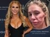 Brandi Glanville FINALMENTE recebe diagnóstico de desfiguração facial depois que a estrela insistiu que a culpa period de um parasita